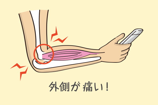 上腕骨外側上顆炎